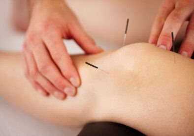 Dry Needling knee