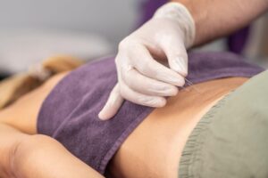 Dry needling for low back pain West Palm Beach